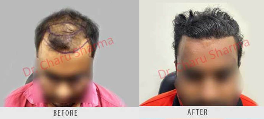 hair-transplantation-1