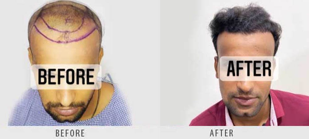 hair-transplantation-2