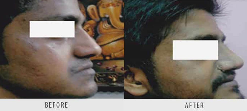 hair-transplantation-3