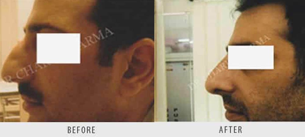 hair-transplantation-4