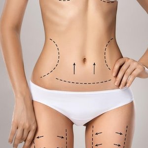liposuction-delhi