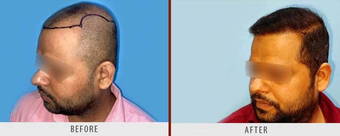 hair-transplant-before-after