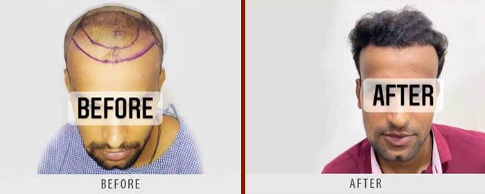 hair-transplant-before-after